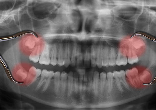 All four locations for Tooth Extractions